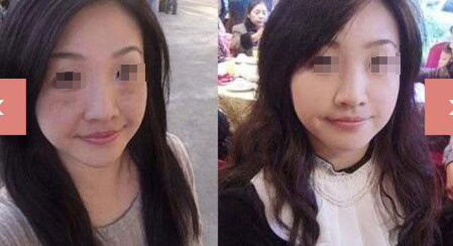 怎么去除脸上的老年斑 如何去除脸上的老年斑