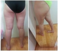 腿部抽脂减肥手术大概需要花多少钱价格 腿部抽脂减肥手术价格一览表 腿部抽脂减肥手术大概需要花多少钱价格 腿部抽脂减肥手术价格一览表