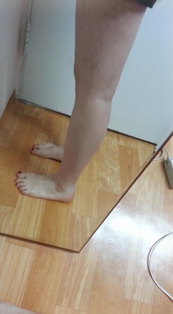 腿部抽脂减肥手术大概需要花多少钱价格 腿部抽脂减肥手术价格一览表