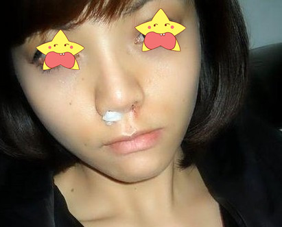 鼻翼缩小整形手术的价格是多少钱 鼻翼缩小整形手术前后对比照片果图