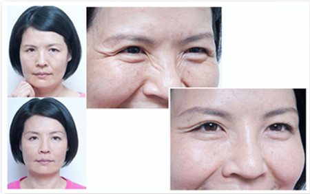 有消祛掉眼角鱼尾纹新方法 注射去除鱼尾纹大概需要多少钱价格