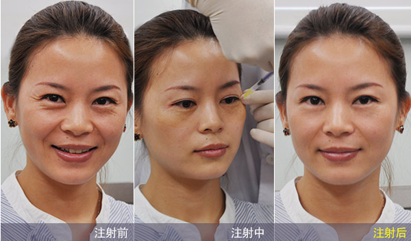 有消祛掉眼角鱼尾纹新方法 注射去除鱼尾纹大概需要多少钱价格