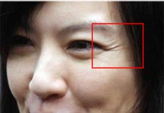 有消祛掉眼角鱼尾纹新方法 注射去除鱼尾纹大概需要多少钱价格