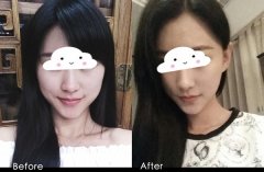 注射打注射瘦脸B****一般大概要多少钱价格 注射打注射瘦脸B****有什么副作用