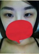 做韩式微创开眼角一般大概多少钱价格 开眼角手术恢复期是多长时间 做韩式微创开眼角一般大概多少钱价格 开眼角手术恢复期是多长时间