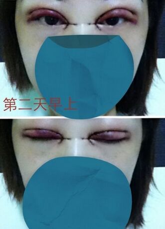做韩式微创开眼角一般大概多少钱价格 开眼角手术恢复期是多长时间
