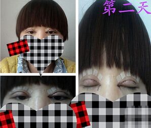 开眼角术后恢复期一般是多长时间 开眼角术后一般多长时间可以恢复