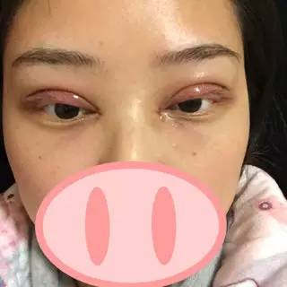 做开眼角手术的果怎么样好看吗 做开眼角手术有什么后遗症