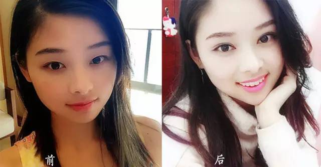 做开眼角手术的果怎么样好看吗 做开眼角手术有什么后遗症