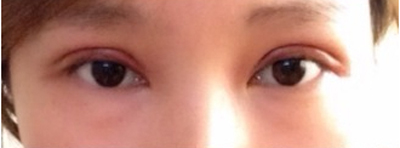 韩式微创开眼角手术的价格多少钱 韩式微创开眼角手术大概一般多少钱价格