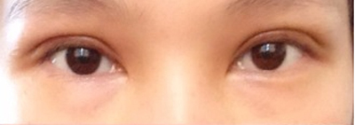 韩式微创开眼角手术的价格多少钱 韩式微创开眼角手术大概一般多少钱价格