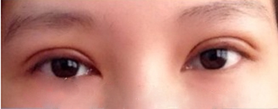 韩式微创开眼角手术的价格多少钱 韩式微创开眼角手术大概一般多少钱价格
