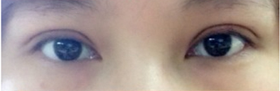 韩式微创开眼角手术的价格多少钱 韩式微创开眼角手术大概一般多少钱价格