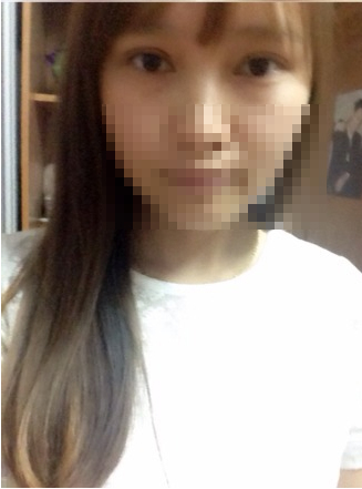 韩式微创开眼角手术的价格多少钱 韩式微创开眼角手术大概一般多少钱价格