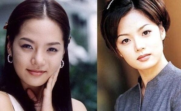 明星开眼角前后对比果照片案例图 开眼角手术的后遗症有哪些