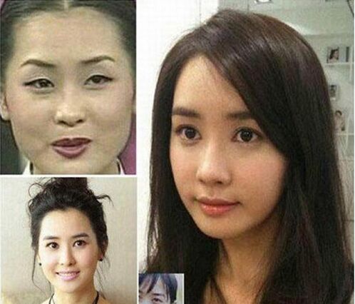 明星开眼角前后对比果照片案例图 开眼角手术的后遗症有哪些