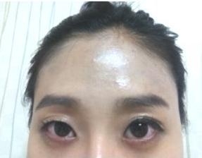 开眼角手术价钱多少钱 开眼角手术前后对比图