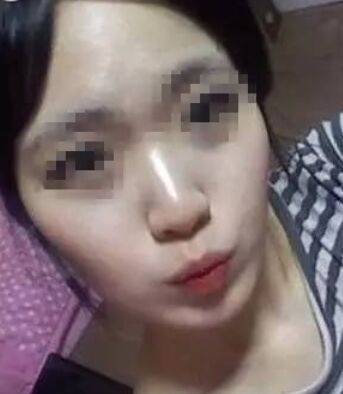 注射打骨f隆鼻的后遗症 做隆鼻整形手术一般大概要多少钱
