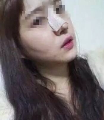 注射打骨f隆鼻的后遗症 做隆鼻整形手术一般大概要多少钱