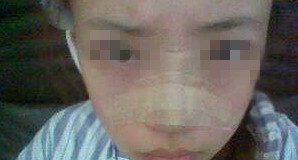 自体耳软骨隆鼻手术大概价格多少钱 自体耳软骨隆鼻过程真人果案例图
