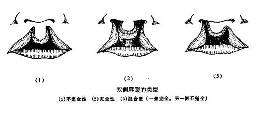 如何缓解兔唇比较有 缓解兔唇需要多少钱