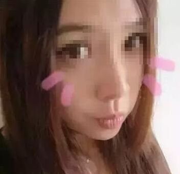 玻尿酸注射隆鼻法果大概一般能够维持多久 注射胶原蛋白隆鼻法果大概一般能够维持多久