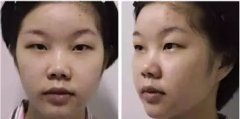 双美胶原蛋白注射式隆鼻大概一般需要多少钱价格费用 双美胶原蛋白注射式隆