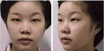 双美胶原蛋白注射式隆鼻大概一般需要多少钱价格费用 双美胶原蛋白注射式隆鼻的果如何怎么样呢