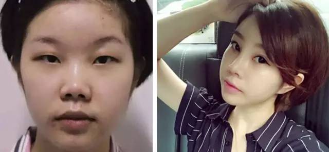 双美胶原蛋白注射式隆鼻大概一般需要多少钱价格费用 双美胶原蛋白注射式隆鼻的果如何怎么样呢