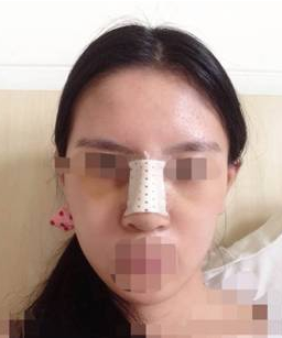 隆鼻子整形一般大概需要花多少钱价格费用 隆鼻子整形一般大约得花多少钱价格费用