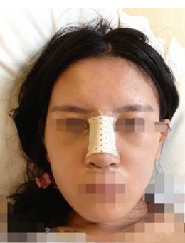 隆鼻子整形一般大概需要花多少钱价格费用 隆鼻子整形一般大约得花多少钱价格费用