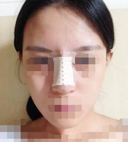 隆鼻子整形一般大概需要花多少钱价格费用 隆鼻子整形一般大约得花多少钱价格费用