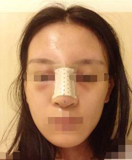 隆鼻子整形一般大概需要花多少钱价格费用 隆鼻子整形一般大约得花多少钱价格费用