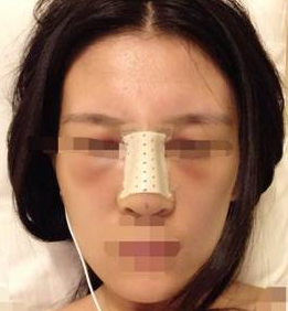 隆鼻子整形一般大概需要花多少钱价格费用 隆鼻子整形一般大约得花多少钱价格费用