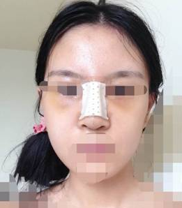 隆鼻子整形一般大概需要花多少钱价格费用 隆鼻子整形一般大约得花多少钱价格费用