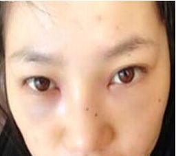 注射式隆鼻前后过程对比果照片案例图