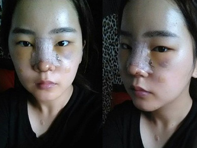 膨体隆鼻手术一般大概需要多少钱费用价格 膨体隆鼻手术过程前后对比照片果案例图