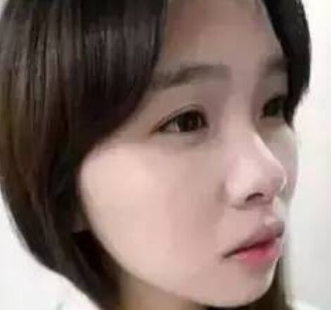 疼痛感较轻隆鼻术果好不好怎么样