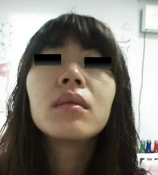 假体隆鼻整形手术是永.久的吗 假体隆鼻整形手术的一般大概费用价格多少钱