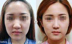 大鼻子整小价格要多少钱 大鼻子整小一般要多少钱