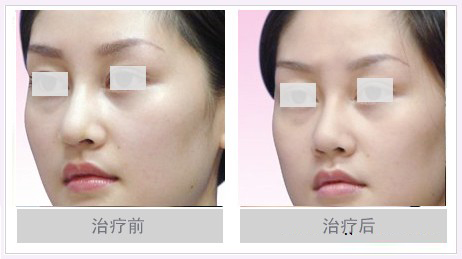 大鼻子整小价格要多少钱 大鼻子整小一般要多少钱