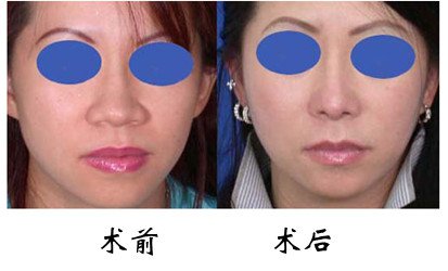 大鼻子整小价格要多少钱 大鼻子整小一般要多少钱