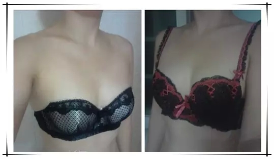 娜高假体隆胸手术一般大概需要多少钱价格费用 娜高隆胸假体取出后遗症降低风险吗