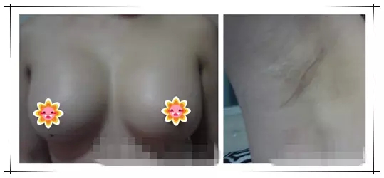 娜高假体隆胸手术一般大概需要多少钱价格费用 娜高隆胸假体取出后遗症降低风险吗