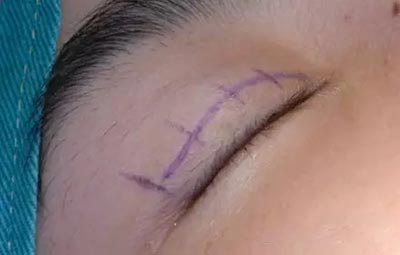 埋线法双眼皮手术果照片真人案例图 埋线法双眼皮恢复过程真人案例果