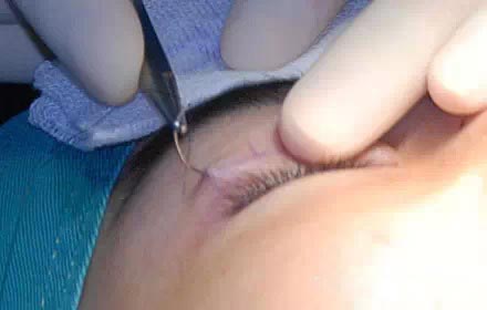埋线法双眼皮手术果照片真人案例图 埋线法双眼皮恢复过程真人案例果照片图