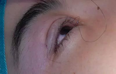 埋线法双眼皮手术果照片真人案例图 埋线法双眼皮恢复过程真人案例果照片图