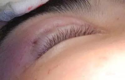 埋线法双眼皮手术果照片真人案例图 埋线法双眼皮恢复过程真人案例果照片图