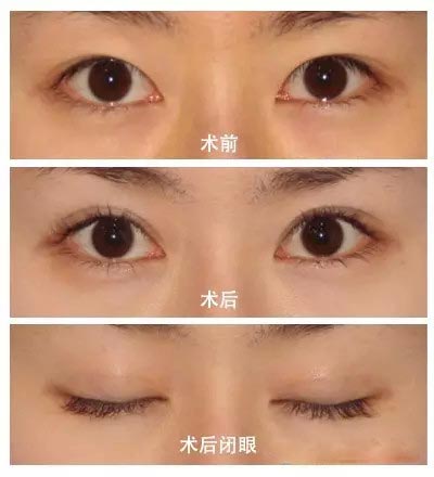 埋线法双眼皮手术果照片真人案例图 埋线法双眼皮恢复过程真人案例果照片图