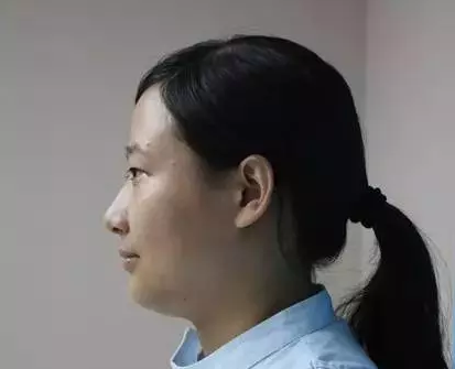 做埋线双眼皮手术恢复时间大概要多久 割埋线双眼皮手术恢复过程真人案例果照片图
